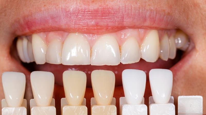 Veneers Webster, TX